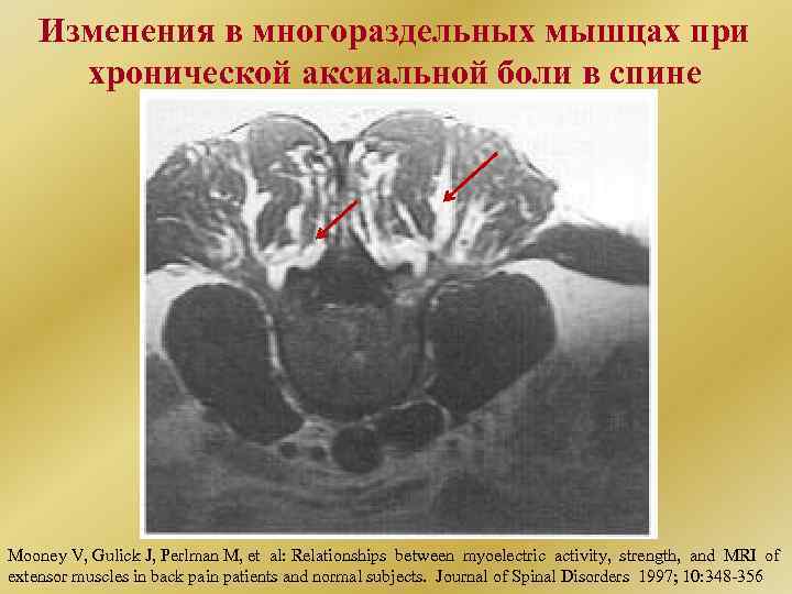 Изменения в многораздельных мышцах при хронической аксиальной боли в спине Mooney V, Gulick J,