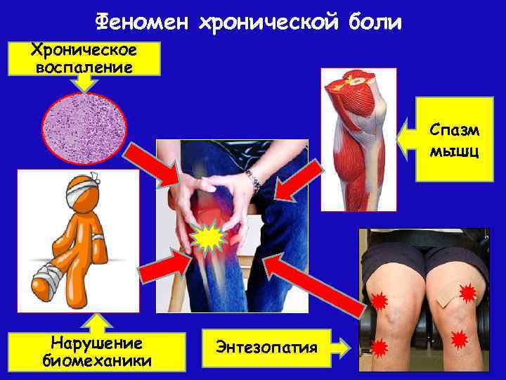Феномен хронической боли Хроническое воспаление Спазм мышц Нарушение биомеханики Энтезопатия 