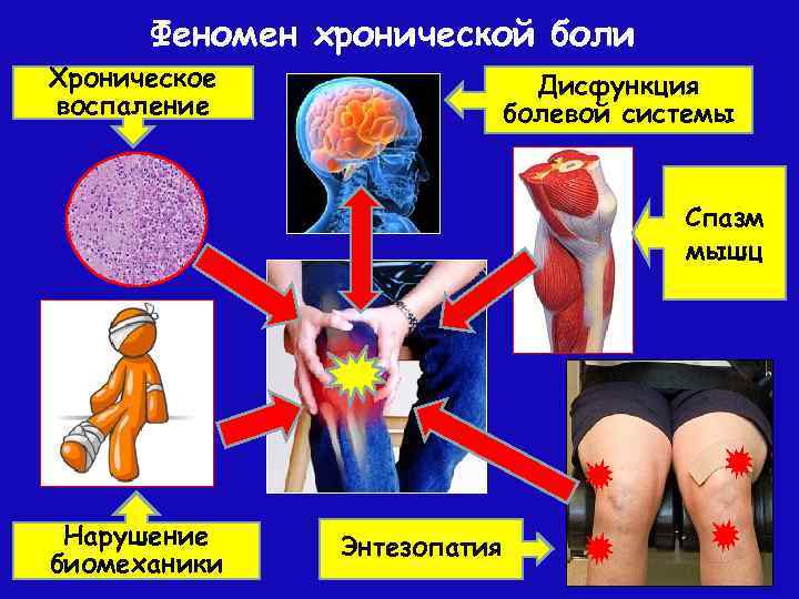 Феномен хронической боли Хроническое воспаление Дисфункция болевой системы Спазм мышц Нарушение биомеханики Энтезопатия 
