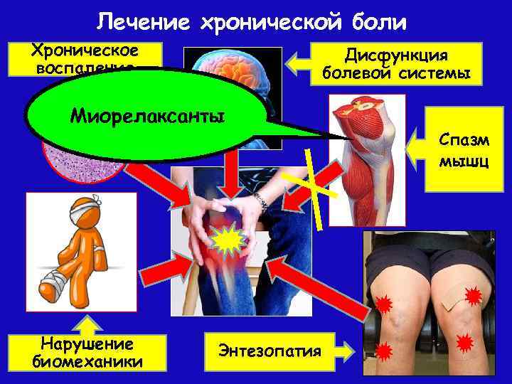 Лечение хронической боли Хроническое воспаление Дисфункция болевой системы Миорелаксанты Нарушение биомеханики Энтезопатия Спазм мышц