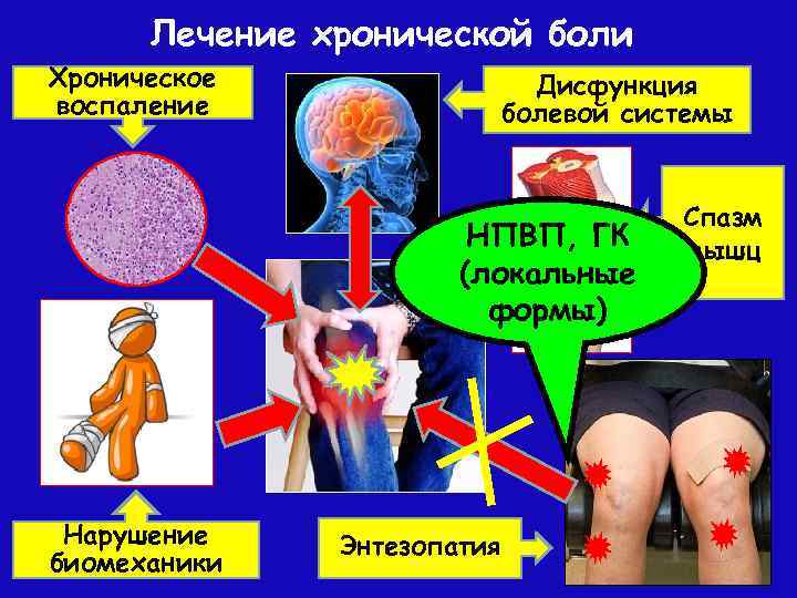 Лечение хронической боли Хроническое воспаление Дисфункция болевой системы НПВП, ГК (локальные формы) Нарушение биомеханики