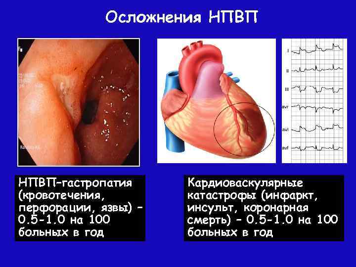 Осложнения НПВП–гастропатия (кровотечения, перфорации, язвы) – 0. 5 -1. 0 на 100 больных в