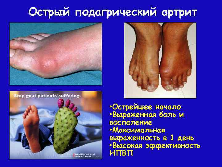 Острый подагрический артрит • Острейшее начало • Выраженная боль и воспаление • Максимальная выраженность