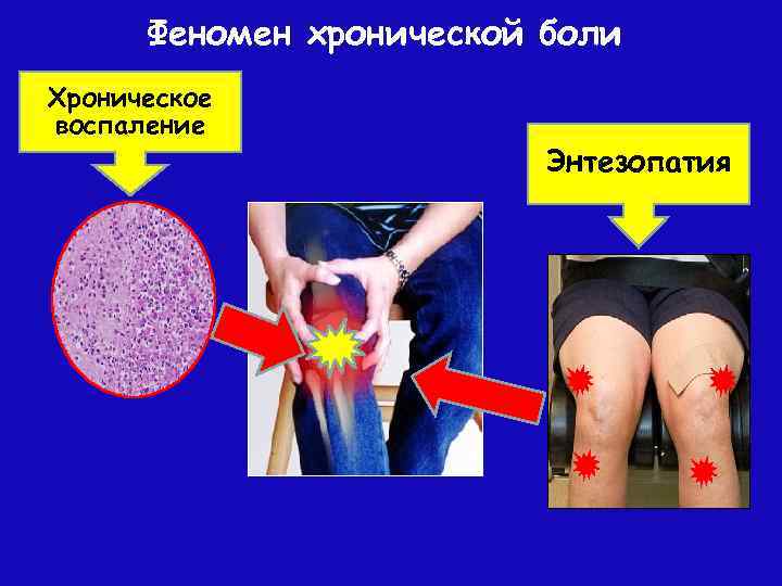 Феномен хронической боли Хроническое воспаление Энтезопатия 