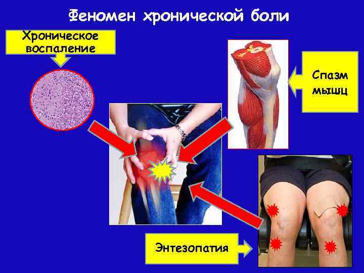 Феномен хронической боли Хроническое воспаление Спазм мышц Энтезопатия 