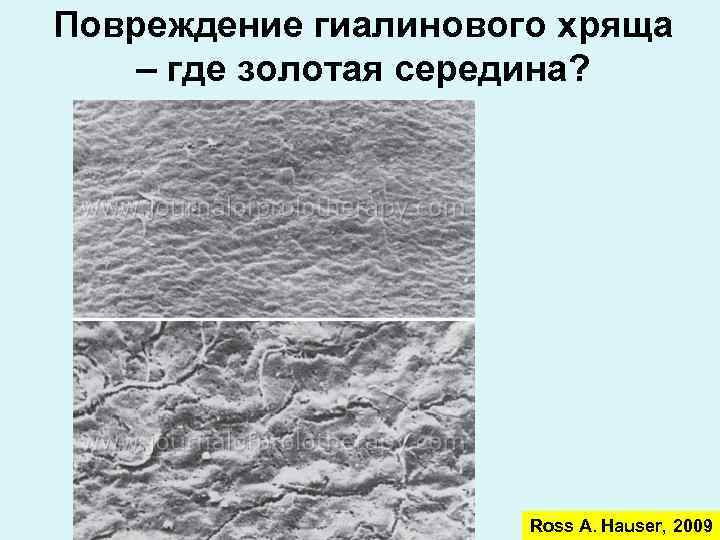 Повреждение гиалинового хряща – где золотая середина? Ross A. Hauser, 2009 