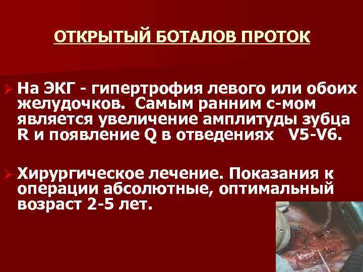 ОТКРЫТЫЙ БОТАЛОВ ПРОТОК Ø На ЭКГ гипертрофия левого или обоих желудочков. Самым ранним с