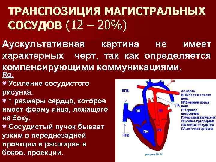 ТРАНСПОЗИЦИЯ МАГИСТРАЛЬНЫХ СОСУДОВ (12 – 20%) Аускультативная картина не имеет характерных черт, так как