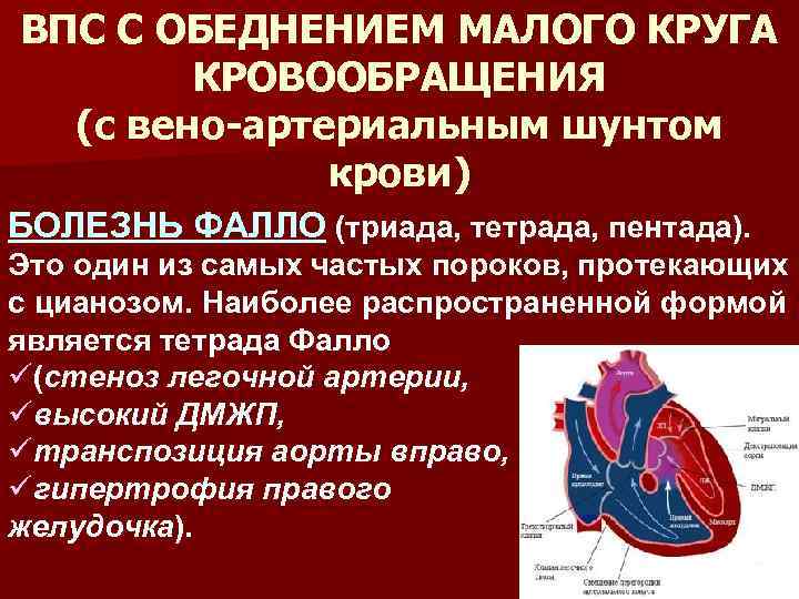 ВПС С ОБЕДНЕНИЕМ МАЛОГО КРУГА КРОВООБРАЩЕНИЯ (с вено артериальным шунтом крови) БОЛЕЗНЬ ФАЛЛО (триада,