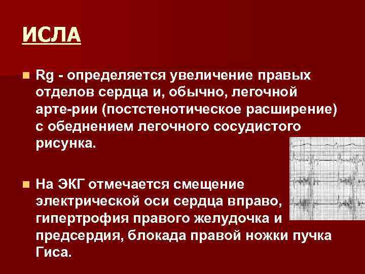 ИСЛА n Rg определяется увеличение правых отделов сердца и, обычно, легочной арте рии (постстенотическое