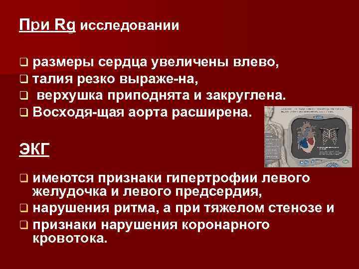 При Rg исследовании q размеры сердца увеличены влево, q талия резко выраже на, q