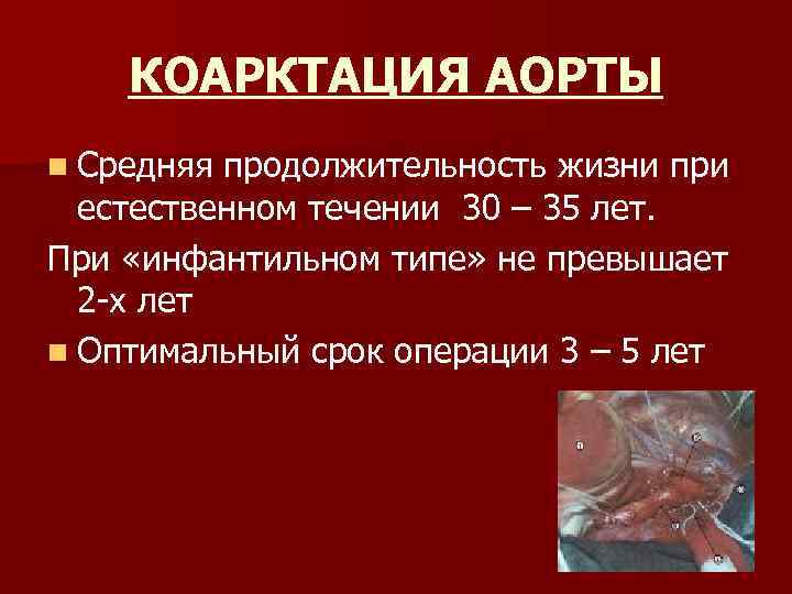 КОАРКТАЦИЯ АОРТЫ n Средняя продолжительность жизни при естественном течении 30 – 35 лет. При