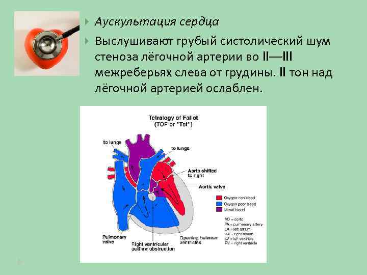  Аускультация сердца Выслушивают грубый систолический шум стеноза лёгочной артерии во II—III межреберьях слева