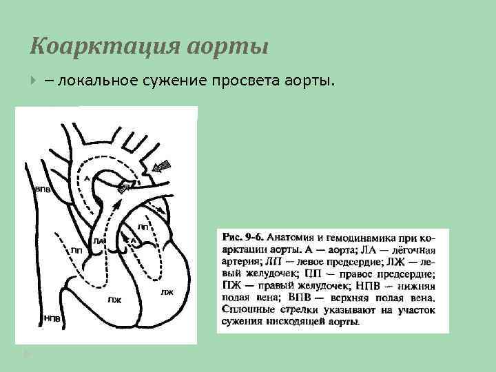 Коарктация аорты – локальное сужение просвета аорты. 