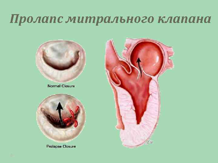 Пролапс митрального клапана 