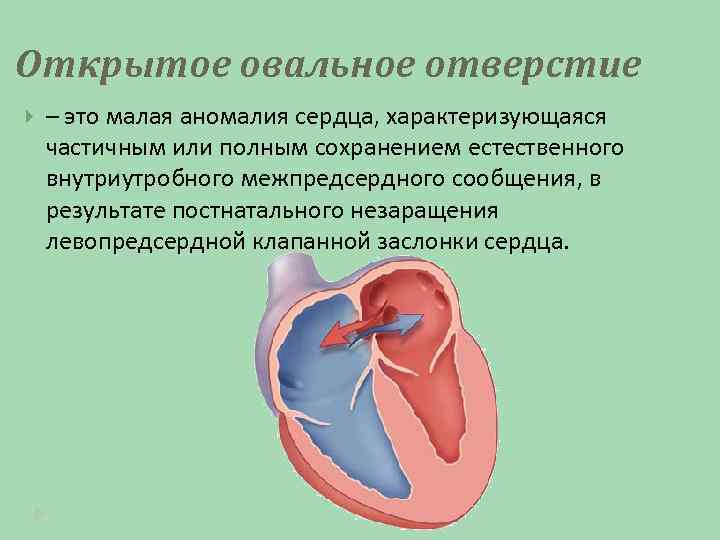 Открытое овальное отверстие – это малая аномалия сердца, характеризующаяся частичным или полным сохранением естественного