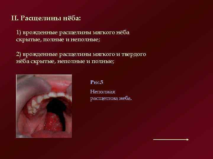 II. Расщелины нёба: 1) врожденные расщелины мягкого нёба скрытые, полные и неполные; 2) врожденные