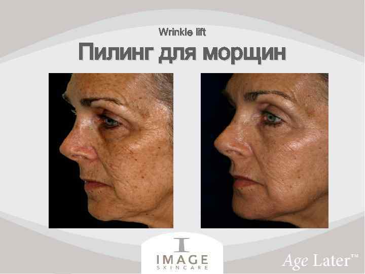 Wrinkle lift Пилинг для морщин 