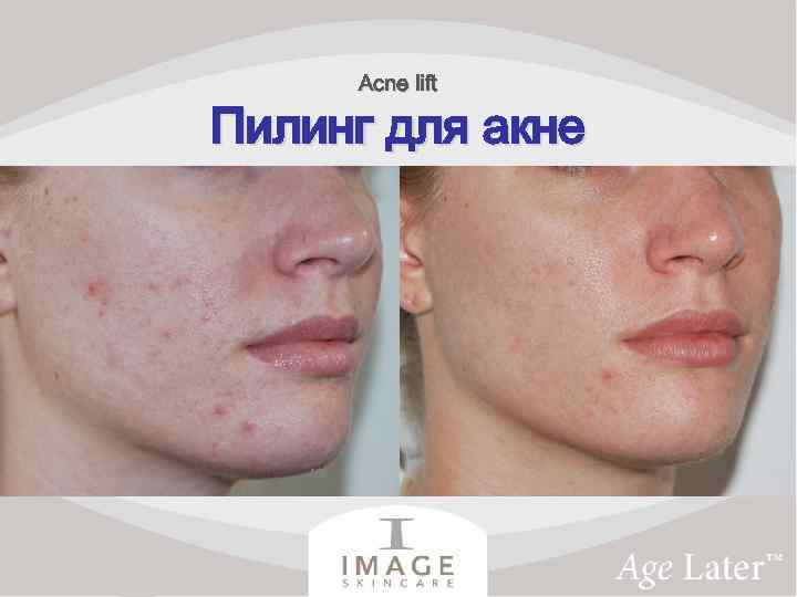 Acne lift Пилинг для акне 