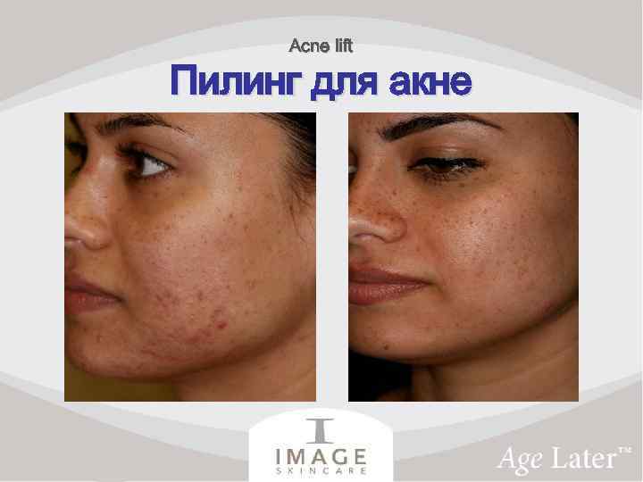 Acne lift Пилинг для акне 