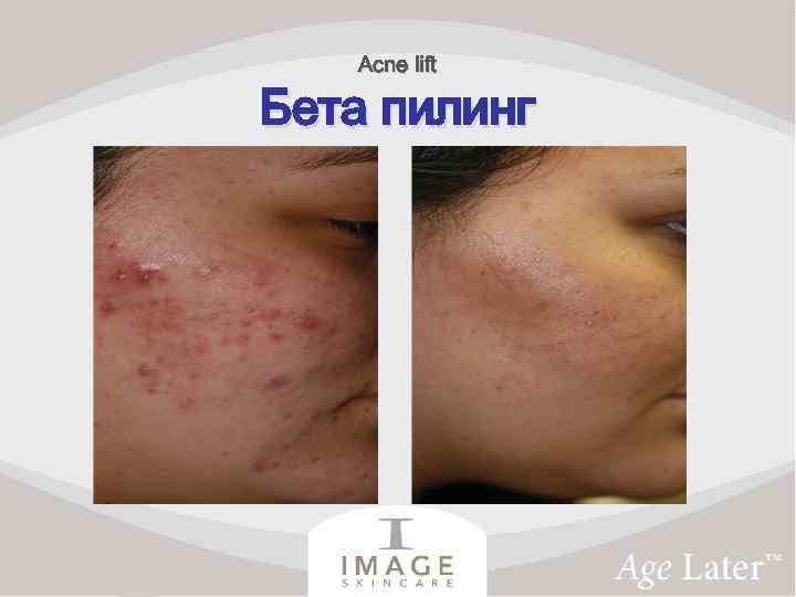 Acne lift Бета пилинг 