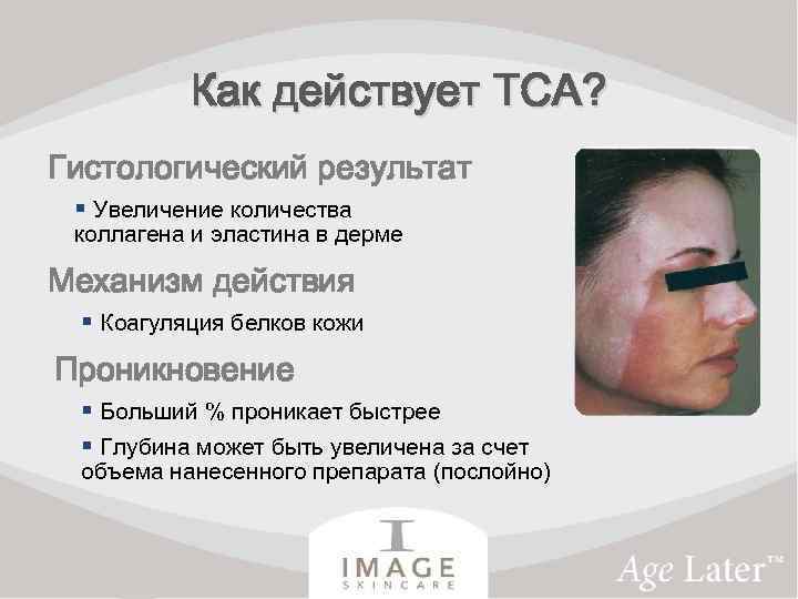 Как действует TCA? Гистологический результат § Увеличение количества коллагена и эластина в дерме Механизм