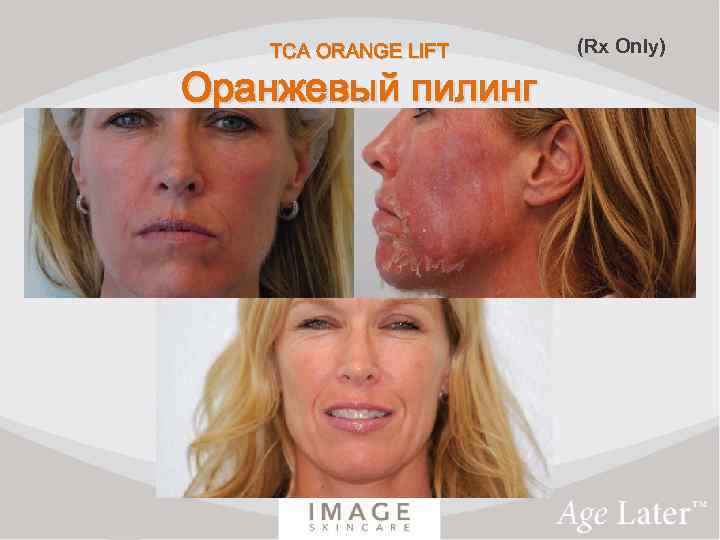 TCA ORANGE LIFT Оранжевый пилинг (Rx Only) 