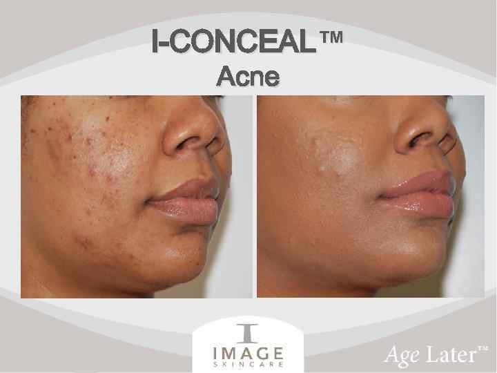 I-CONCEAL™ Acne 