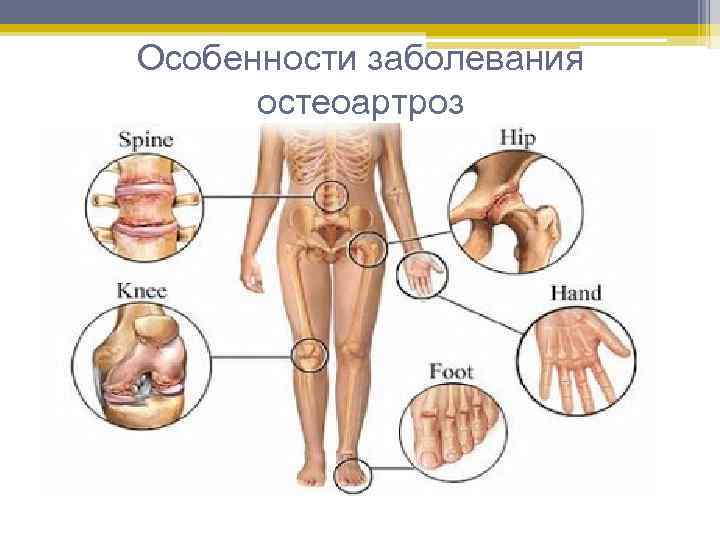 Особенности заболевания остеоартроз 