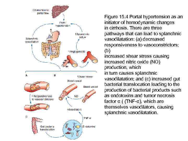 Figure 15. 4 Portal hypertension as an initiator of hemodynamic changes in cirrhosis. There