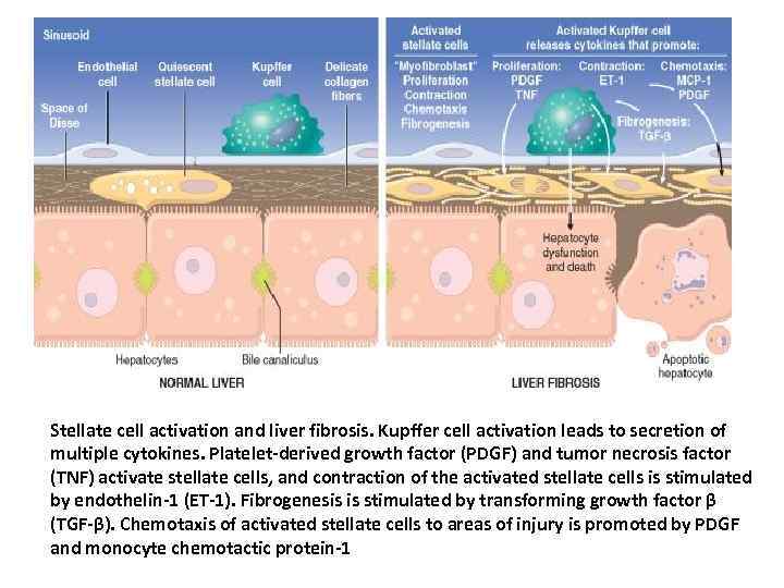 Stellate cell activation and liver fibrosis. Kupffer cell activation leads to secretion of multiple