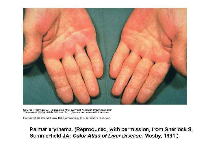 Palmar erythema. (Reproduced, with permission, from Sherlock S, Summerfield JA: Color Atlas of Liver