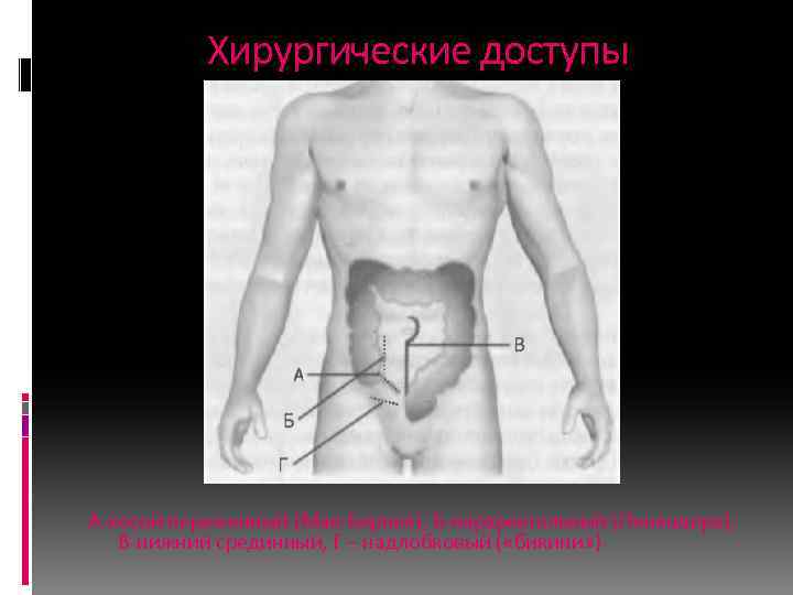 Хирургические доступы А-косой переменный (Мак-Бернея), Б-параректальный (Ленандера), В-нижний срединный, Г – надлобковый ( «бикини»