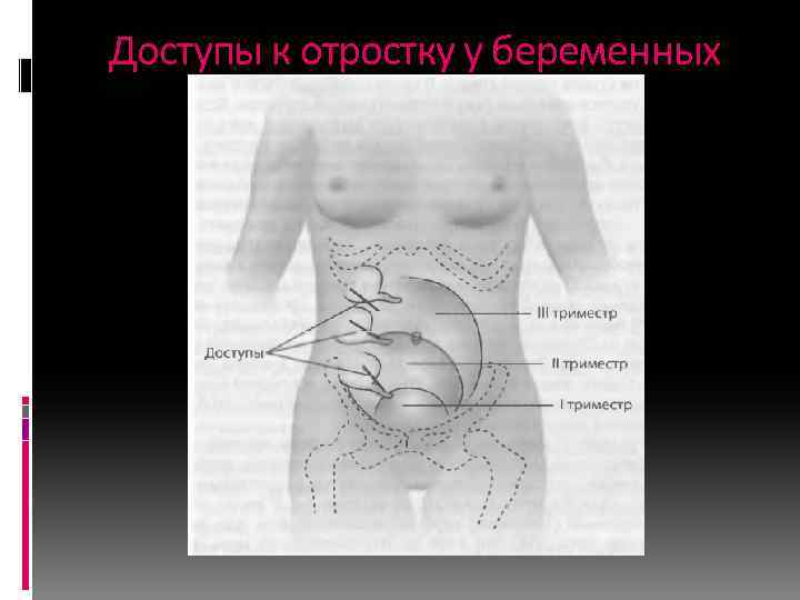 Доступы к отростку у беременных 