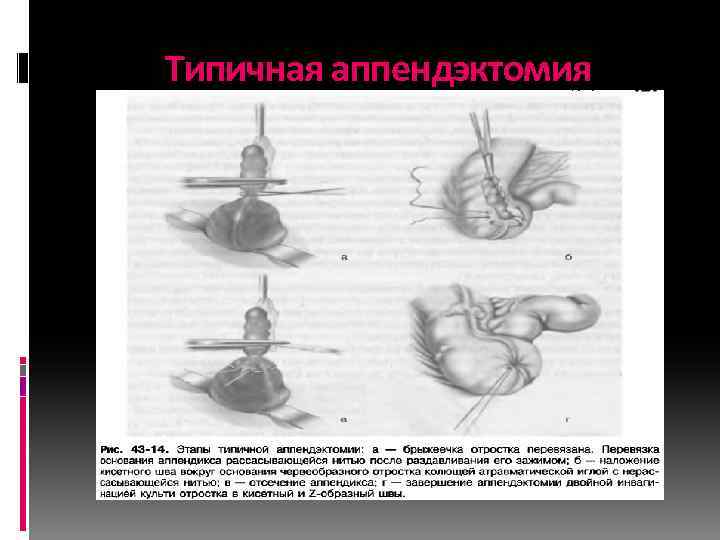 Типичная аппендэктомия 