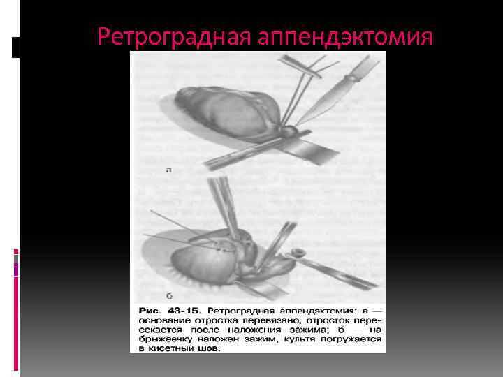 Ретроградная аппендэктомия 