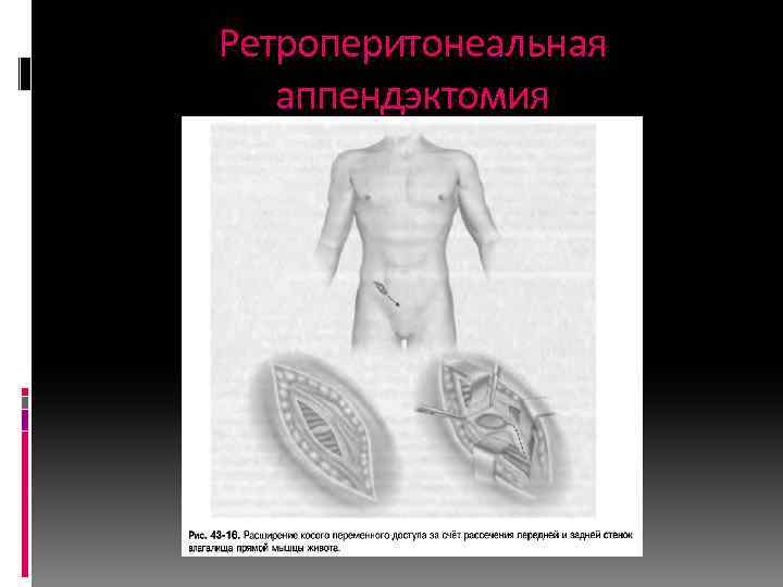 Ретроперитонеальная аппендэктомия 