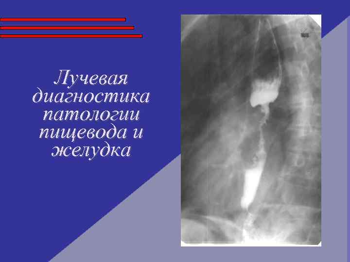Лучевая диагностика патологии пищевода и желудка 