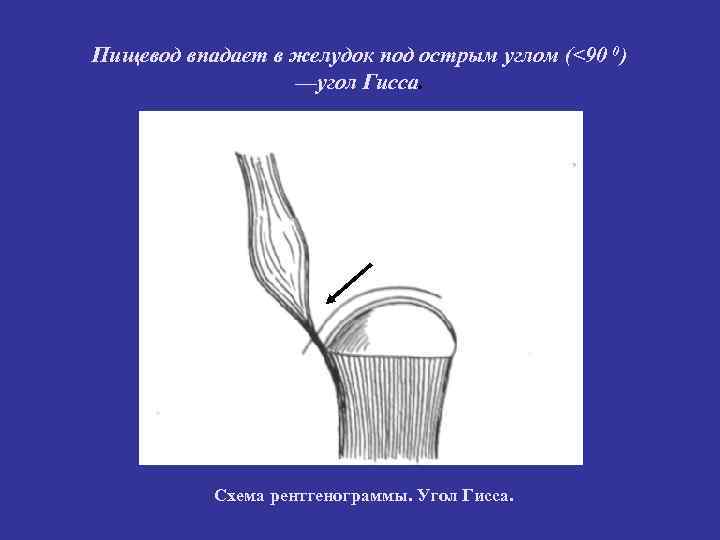 Пищевод впадает в желудок под острым углом (<90 0) —угол Гисса. Схема рентгенограммы. Угол