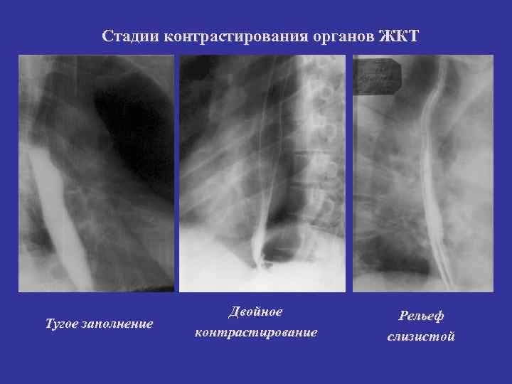 Стадии контрастирования органов ЖКТ Тугое заполнение Двойное контрастирование Рельеф слизистой 