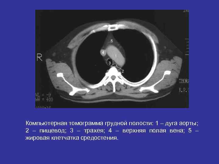 Компьютерная томограмма грудной полости: 1 – дуга аорты; 2 – пищевод; 3 – трахея;