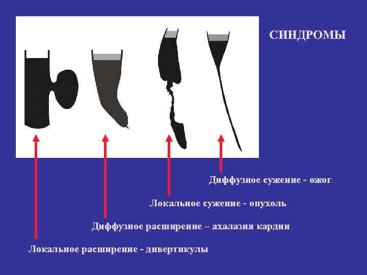 СИНДРОМЫ Диффузное сужение - ожог Локальное сужение - опухоль Диффузное расширение – ахалазия кардии