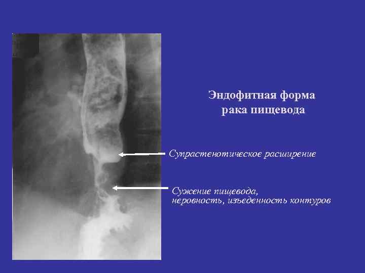 Эндофитная форма рака пищевода Супрастенотическое расширение Сужение пищевода, неровность, изъеденность контуров 