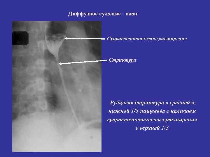 Диффузное сужение - ожог Супрастенотическое расширение Стриктура Рубцовая стриктура в средней и нижней 1/3