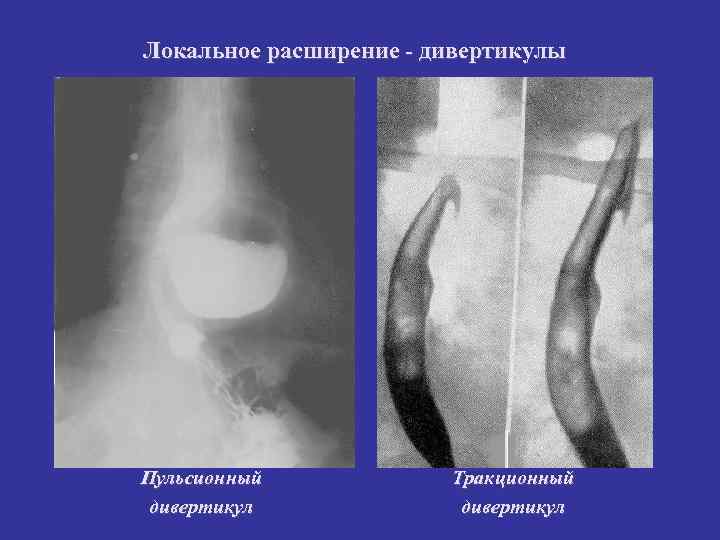 Локальное расширение - дивертикулы Пульсионный дивертикул Тракционный дивертикул 