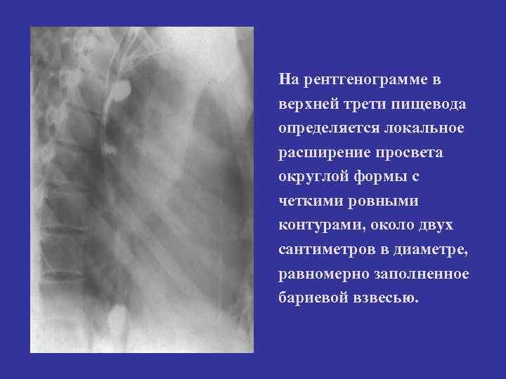 На рентгенограмме в верхней трети пищевода определяется локальное расширение просвета округлой формы с четкими