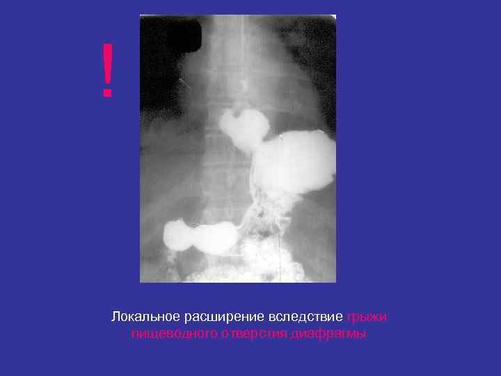 ! Локальное расширение вследствие грыжи пищеводного отверстия диафрагмы 