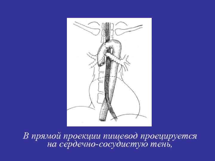 В прямой проекции пищевод проецируется на сердечно-сосудистую тень, 