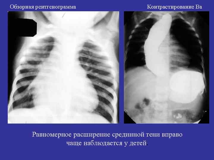 Обзорная рентгенограмма Контрастирование Ва Равномерное расширение срединной тени вправо чаще наблюдается у детей. 