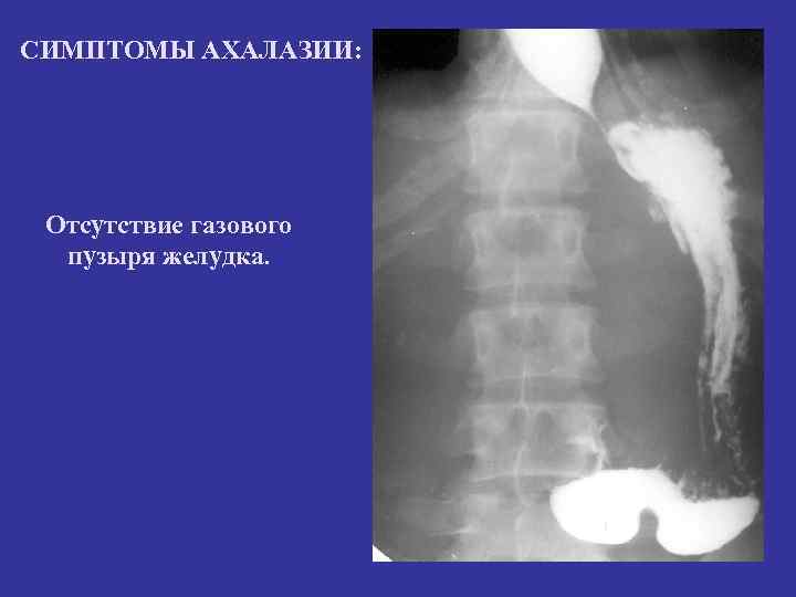СИМПТОМЫ АХАЛАЗИИ: Отсутствие газового пузыря желудка. 